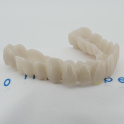 X5 Zahnverblendung - Oberkiefer - Zahnfarbe Natur